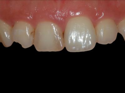 [심미 치료] 치아 형태, 잇몸 라인 개선